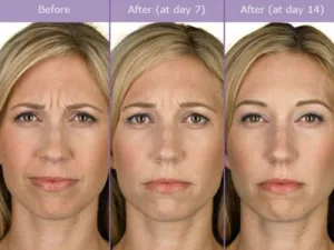 Botox 1 300x225 1