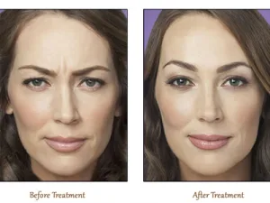 Botox 2 300x225 1