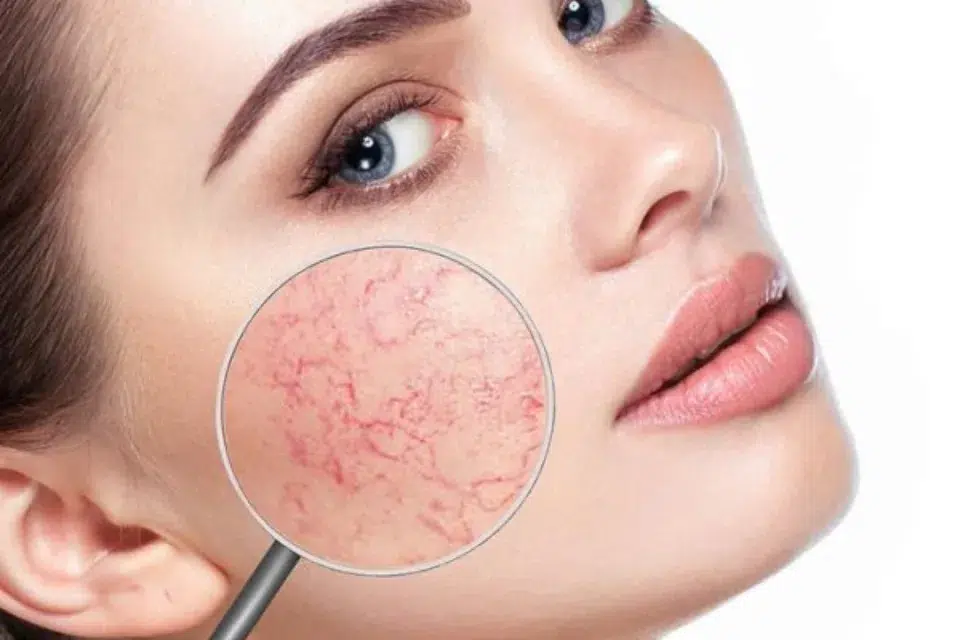 Vein On Face 960x640 1